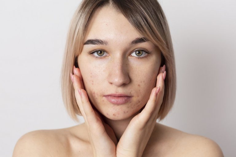 Five Acne Treatment Myths